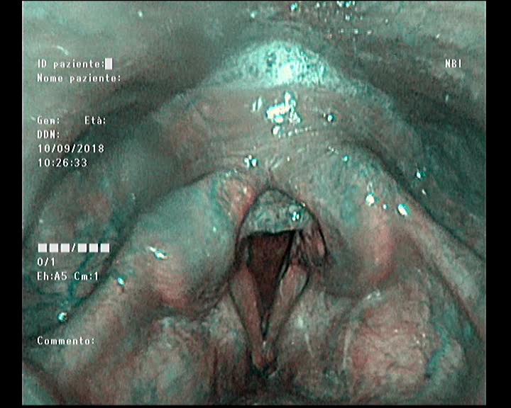 Reflusso laringeo evidenziato con tecnica NBI